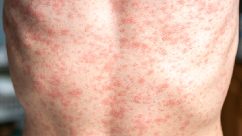 A person’s body is covered in a rash, measles.