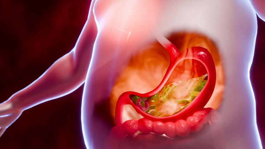 Symptoms of acid reflux or excess acid in the stomach. Gastric juice and intestinal model within the abdominal cavity. Burning sensation in the middle of the chest, acid reflux. 3D Rendering.