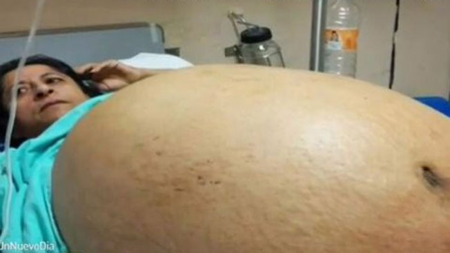 México: extirpan tumor gigante a mujer